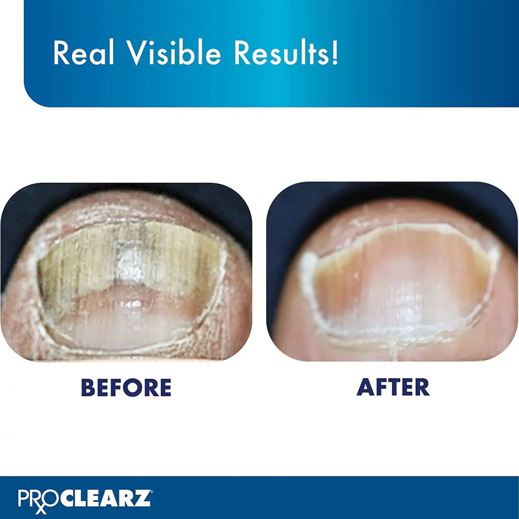 ProClearz Brite Now Nail Treatment, Restores The Appearance Of Damaged & Discolored Nails, Peel-Away Technology, Brightening & Sizemoothing Nail Repair, 0.5 Ounce